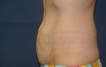 Tummy Tuck Before & After Patient #21244