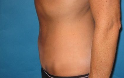 Tummy Tuck Before & After Patient #21244