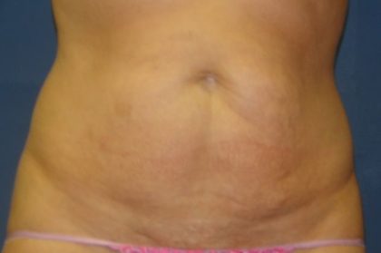 Tummy Tuck Before & After Patient #21246