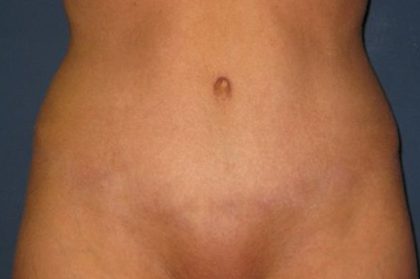 Tummy Tuck Before & After Patient #21246