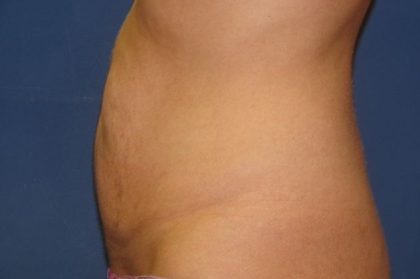 Tummy Tuck Before & After Patient #21246