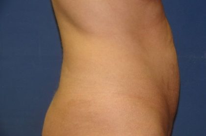 Tummy Tuck Before & After Patient #21246