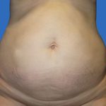 Tummy Tuck Before & After Patient #21249