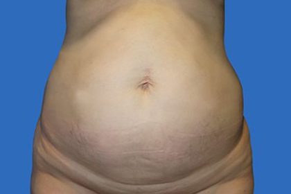 Tummy Tuck Before & After Patient #21249
