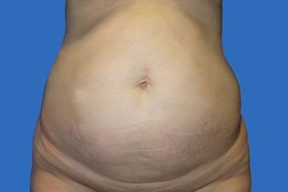 Tummy Tuck Before & After Patient #21249