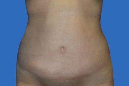 Tummy Tuck Before & After Patient #21249