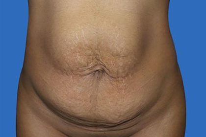 Tummy Tuck Before & After Patient #21248