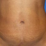 Tummy Tuck Before & After Patient #21248