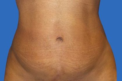 Tummy Tuck Before & After Patient #21248