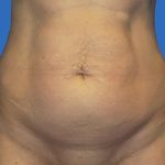 Tummy Tuck Before & After Patient #21251