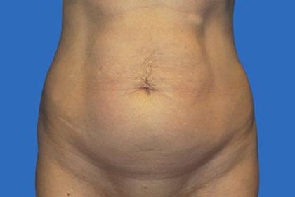 Tummy Tuck Before & After Patient #21251