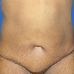 Tummy Tuck Before & After Patient #21252