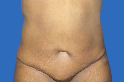 Tummy Tuck Before & After Patient #21252