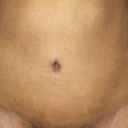 Tummy Tuck Before & After Patient #21252