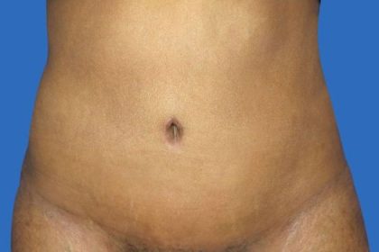 Tummy Tuck Before & After Patient #21252