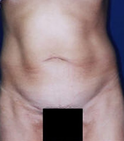 Tummy Tuck Before & After Patient #21253