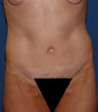 Tummy Tuck Before & After Patient #21253