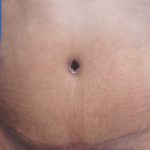Tummy Tuck Before & After Patient #21254