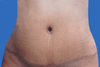 Tummy Tuck Before & After Patient #21254
