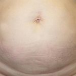 Tummy Tuck Before & After Patient #21255