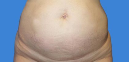 Tummy Tuck Before & After Patient #21255