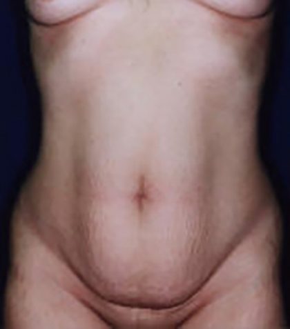 Tummy Tuck Before & After Patient #21256