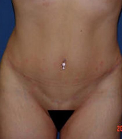 Tummy Tuck Before & After Patient #21256