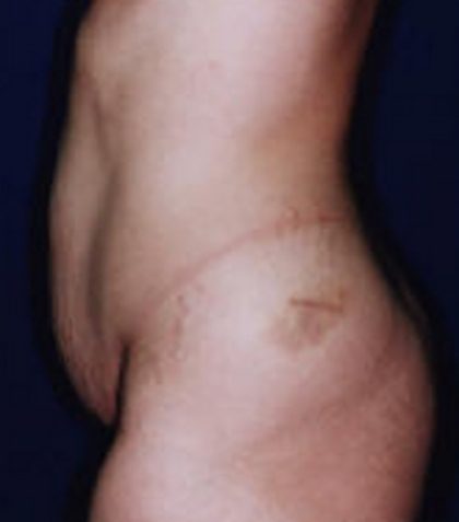 Tummy Tuck Before & After Patient #21256
