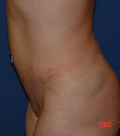 Tummy Tuck Before & After Patient #21256