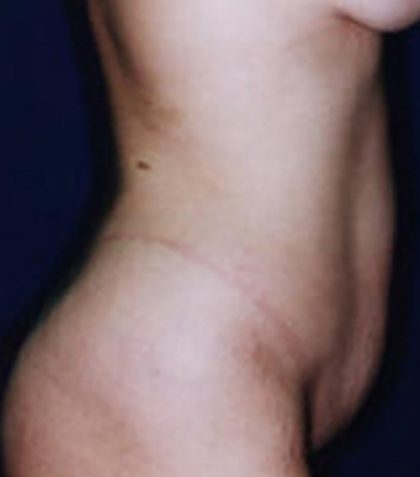 Tummy Tuck Before & After Patient #21256