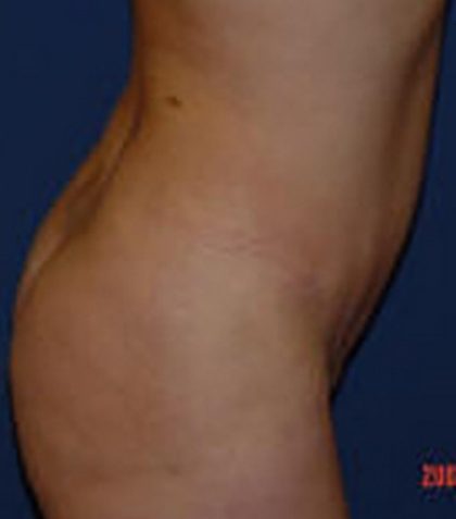 Tummy Tuck Before & After Patient #21256