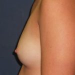 Breast Augmentation Before & After Patient #20852