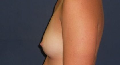 Breast Augmentation Before & After Patient #20852