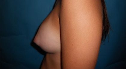 Breast Augmentation Before & After Patient #20852