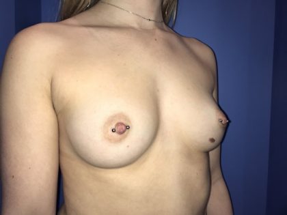 Breast Augmentation Before & After Patient #20853