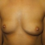 Breast Augmentation Before & After Patient #20855