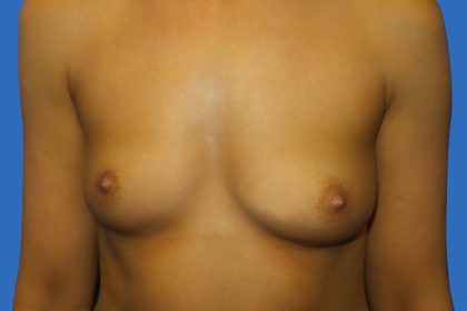 Breast Augmentation Before & After Patient #20855