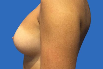 Breast Augmentation Before & After Patient #20855