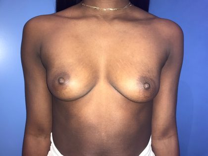Breast Augmentation Before & After Patient #20858