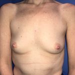 Breast Augmentation Before & After Patient #20859