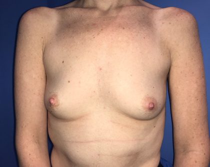 Breast Augmentation Before & After Patient #20859