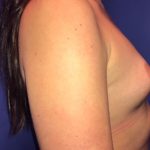 Breast Augmentation Before & After Patient #20878