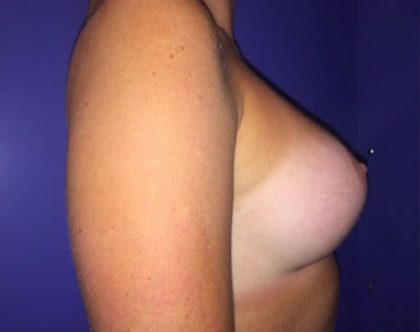 Breast Augmentation Before & After Patient #20878