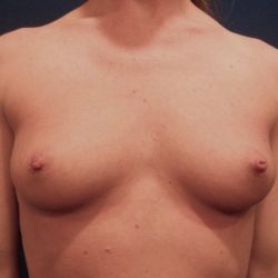 Breast Augmentation Before & After Patient #20861