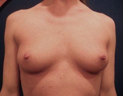 Breast Augmentation Before & After Patient #20861