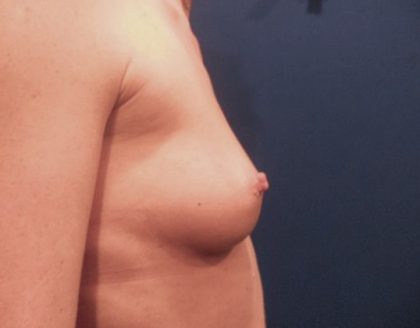 Breast Augmentation Before & After Patient #20861