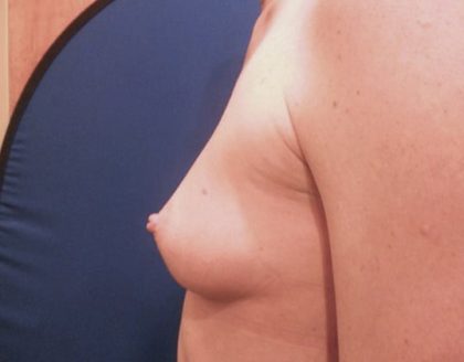 Breast Augmentation Before & After Patient #20861