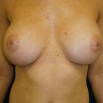 Breast Augmentation Before & After Patient #20862