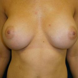 Breast Augmentation Before & After Patient #20862