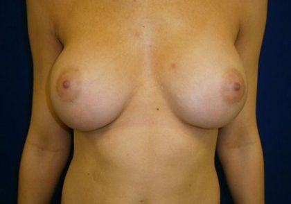 Breast Augmentation Before & After Patient #20862